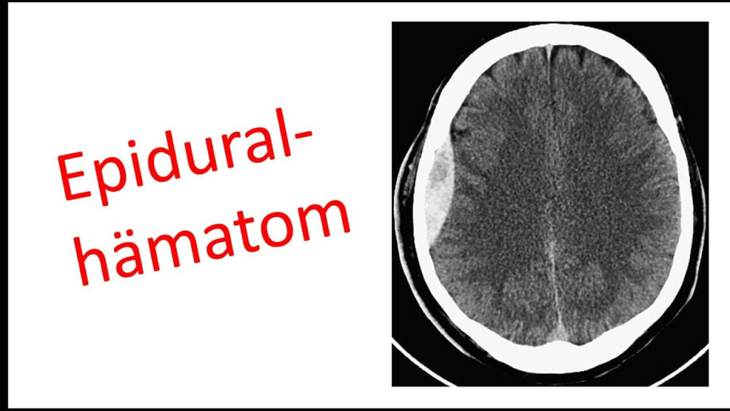 Epidural Hematoma on a CT Scan, Showing Biconvex Hematoma in the Head.