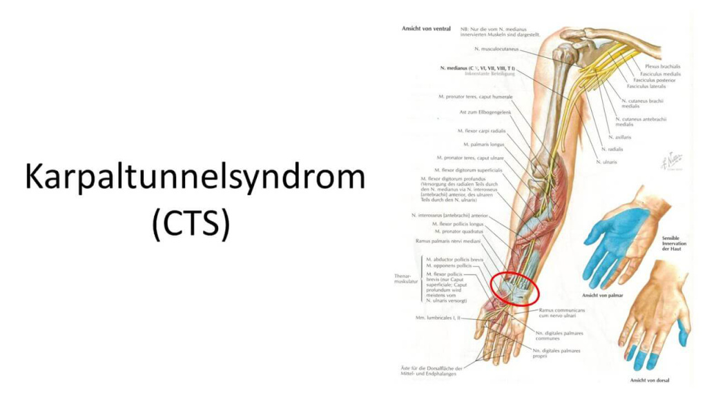 Diagram of Carpal Tunnel Syndrome (CTS) with Nerves and Muscles of the Arm.