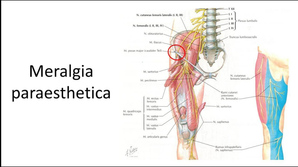 Illustration of Meralgia Paresthetica with Anatomical Nerve and Muscle Structures.