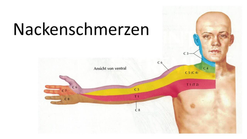 Schematic Representation of Neck Pain with Arm Radiation and Segments.