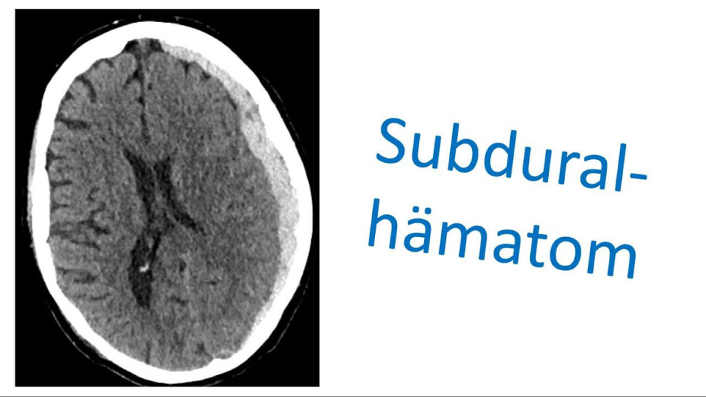 CT Image of a Subdural Hematoma in the Human Brain.