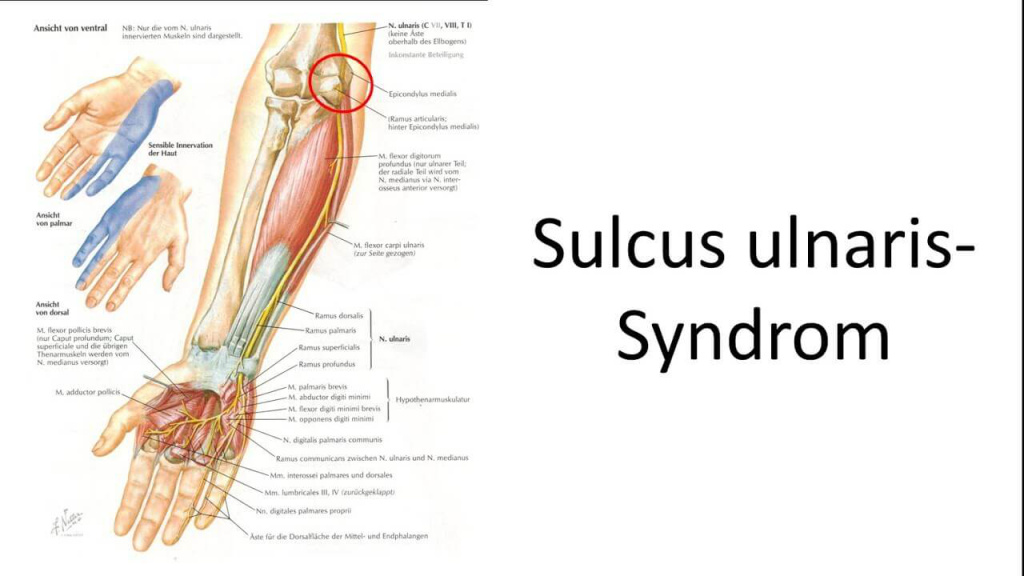 Anatomical Illustration of Ulnar Sulcus Syndrome at the Elbow and Hand.