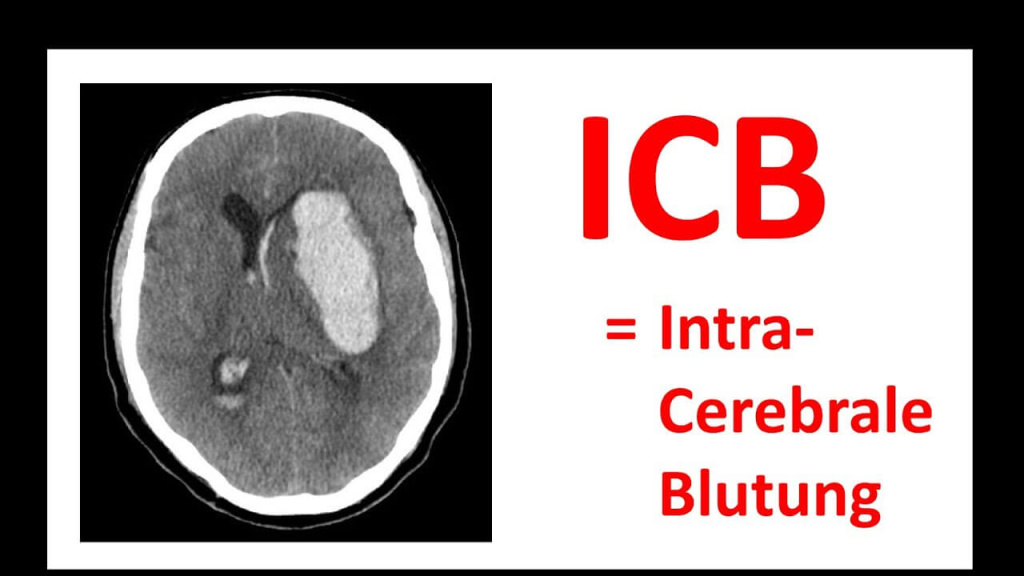 CT-Bild des Schädels mit Hinweis auf intracerebrale Blutung (ICB).